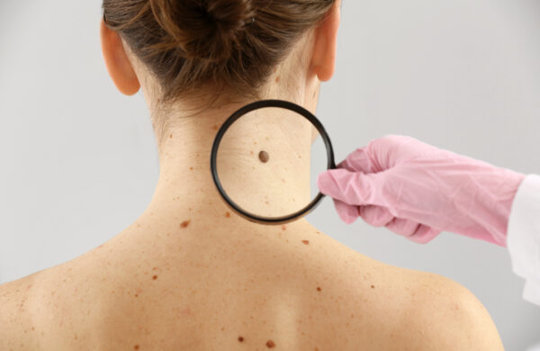 3 jeitos fáceis de se proteger do câncer de pele