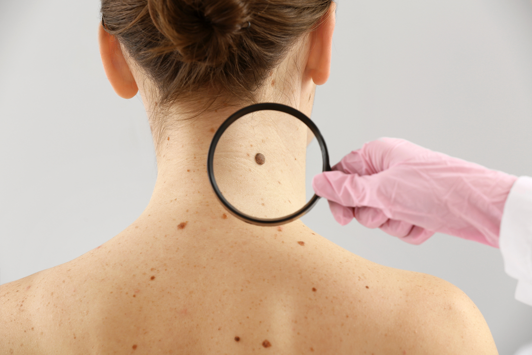 Você está visualizando atualmente 3 jeitos fáceis de se proteger do câncer de pele